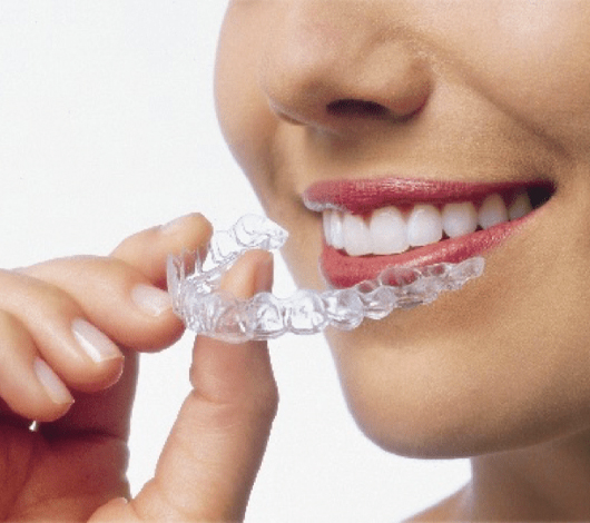 HDM Clear Aligners