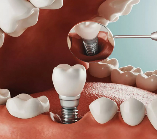 Dental Implants