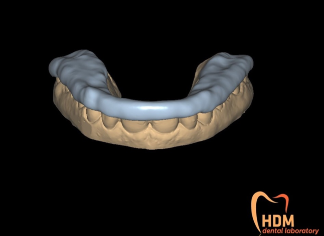 3D Printed bite splints