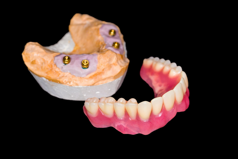 Overdenture