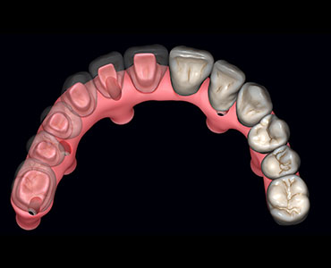 Toronto bridge dental